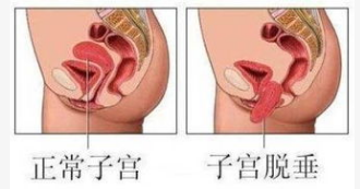 產(chǎn)后恢復，盆底肌修復的功能障礙